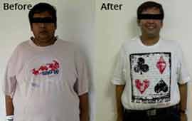 Laparoscopic Metabolic/Bariatric (weight loss) Surgery